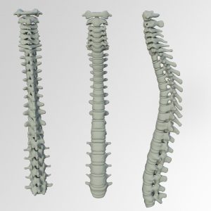 scoliosis